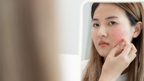 Tự thải độc da nhiễm corticoid đúng cách