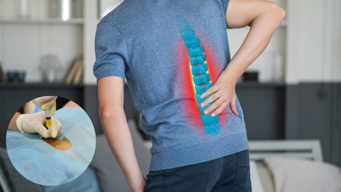 Thoái hóa cột sống thắt lưng và cách điều trị hiệu quả