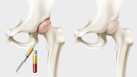 Thoái hóa khớp háng: Nguyên nhân, triệu chứng và cách điều trị bệnh