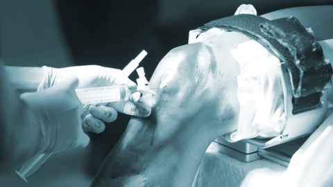 Tiêm huyết tương giàu tiểu cầu ở bệnh nhân thoái hóa khớp