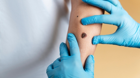 Cảnh báo nguy hiểm từ ung thư da hắc tố và cách phòng bệnh