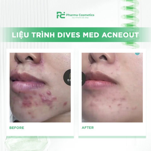 DIVES MED ACNEOUT: Meso Tiêu Cồi Mụn, Bình Thường Hóa Da Dầu Mụn từ Đức