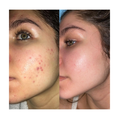Differin Adapalene Gel 0.1%: Giải Pháp Trị Mụn Retinoid Chuẩn Y Khoa Cho Làn Da Sạch Mụn