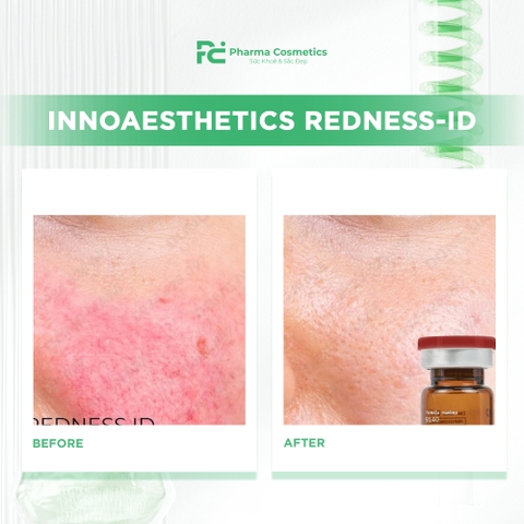 INNOAESTHETICS REDNESS-ID: Giải Pháp Triệt Để Cho Da Rosacea, Giãn Mao Mạch & Nhiễm Corticoid