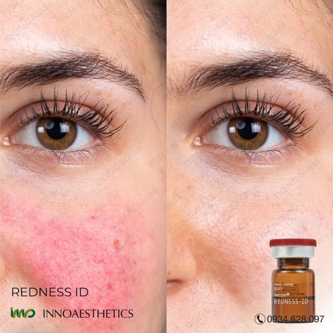 INNOAESTHETICS REDNESS-ID: Giải Pháp Triệt Để Cho Da Rosacea, Giãn Mao Mạch & Nhiễm Corticoid