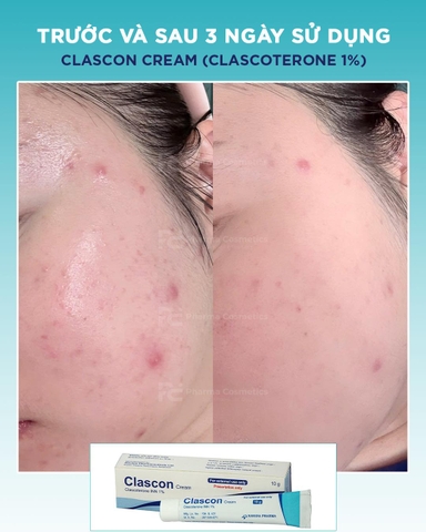 CLASCON CREAM (CLASCOTERONE 1%): Đột Phá Mới Trong Điều Trị Mụn Nội Tiết & Giảm Nhờn