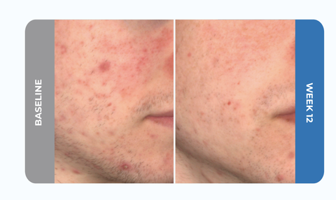 Winlevi Cream 1% Clascoterone: Đột Phá Điều Trị Mụn Nội Tiết Đầu Tiên Sau 40 Năm