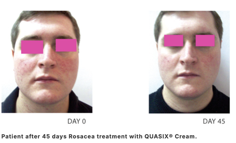 QUASIX GEL 30g / GEL ĐỂ KIỂM SOÁT TÌNH TRẠNG ĐỎ BỪNG MẶT VÀ BỆNH ROSACEA Ở DA NHỜN ( DA DẦU, DA HỖN HỢP) 