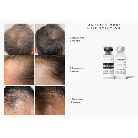 ANTEAGE MDX HAIR EXOSOME SOLUTION / DUNG DỊCH TÁI TẠO, PHỤC HỒI NANG TÓC  
