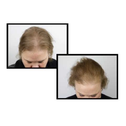 ANTEAGE MD® HAIR SOLUTION / TINH CHẤT GIẢM RỤNG VÀ KÍCH THÍCH MỌC TÓC 