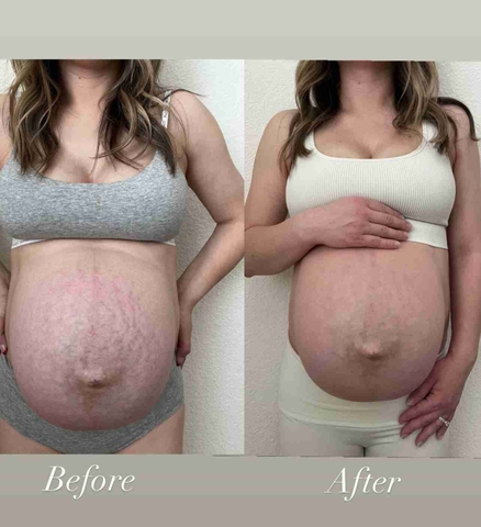 TINH DẦU Bio‑Oil 125ML/ TRỊ RẠN, DƯỠNG ẨM VÀ LÀM ĐỀU MÀU DA