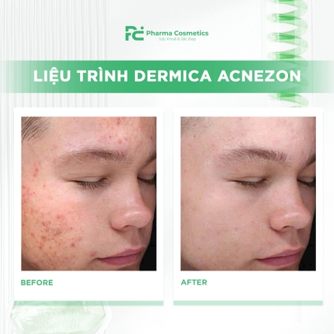 DERMICA ACNEZON: Giải Pháp Meso Tiêu Viêm, Ngăn Sẹo Mụn Cấp Tốc