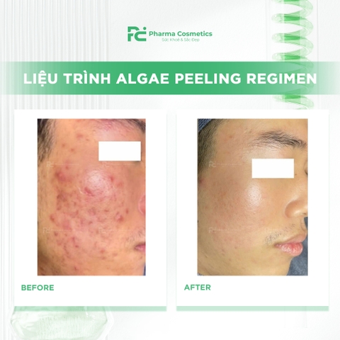 DECAAR ALGAE PEELING REGIMEN: Vi Tảo Sinh Trị Liệu Gen