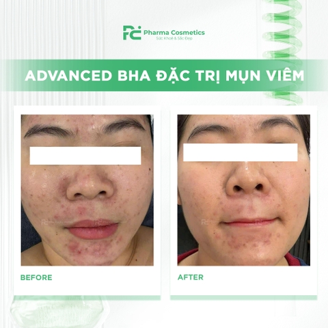ADVANCED BHA ĐẶC TRỊ MỤN: Giải Pháp Chuyên Sâu Cho Da Dầu & Mụn Cấp Độ Nặng
