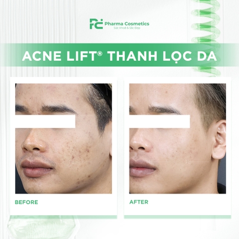 ACNE LIFT® THANH LỌC DA: Chấm Dứt Tình Trạng Bít Tắc và Mụn Ẩn