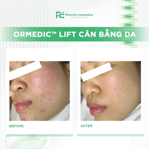 ORMEDIC™ LIFT CÂN BẰNG DA: An Toàn Tuyệt Đối Cho Da Mẹ Bầu & Nhạy Cảm