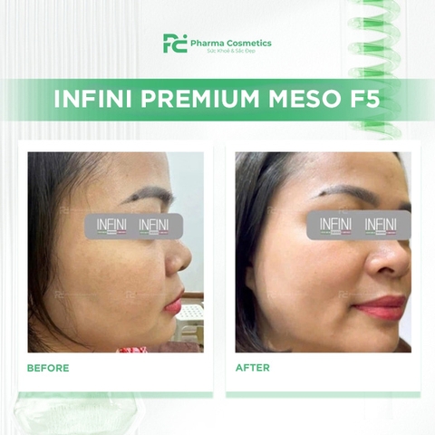 INFINI PREMIUM MESO F5: Giải Pháp Meso Trẻ Hóa Tế Bào Toàn Diện