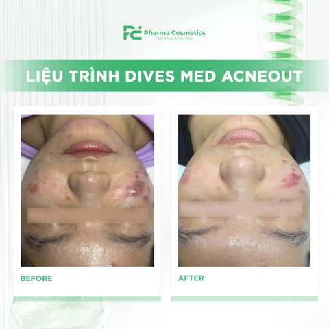 DIVES MED ACNEOUT: Meso Tiêu Cồi Mụn, Bình Thường Hóa Da Dầu Mụn từ Đức
