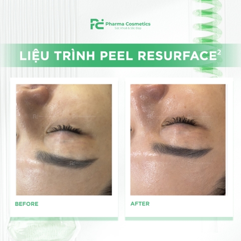 RESURFACE²: Liệu Trình Peel Tái Tạo Tế Bào & Trẻ Hóa Chuyên Sâu Từ Ý