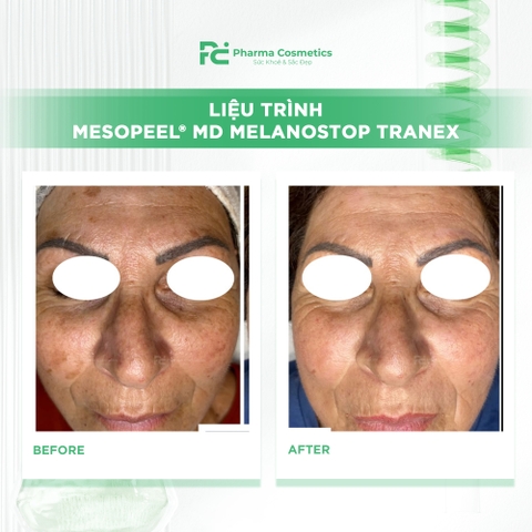 MESOPEEL® MD MELANOSTOP TRANEX: Giải Pháp Peel Đặc Trị Nám & Tăng Sắc Tố Chuyên Sâu