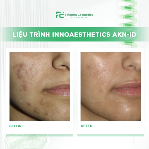 INNOAESTHETICS AKN-ID: Mesotherapy Đặc Trị Mụn và Da Dầu Hàng Đầu Châu Âu