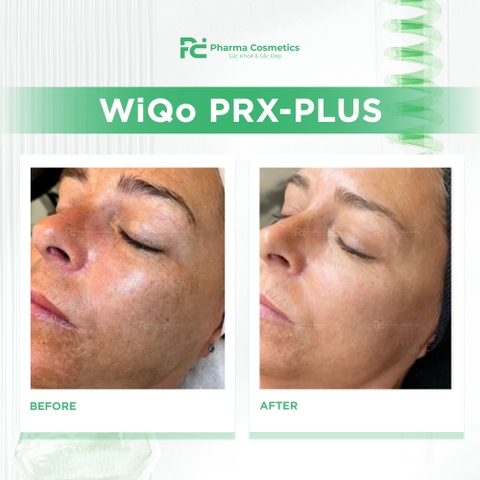 WiQo PRX-PLUS: Giải Pháp Trẻ Hoá Toàn Diện, Không Xâm Lấn