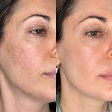 PHARMAFORM B9-12 PLACENTA SERUM: Tinh Chất Chuyên Biệt - Phục Hồi & Tái Tạo Làn Da Tổn Thương