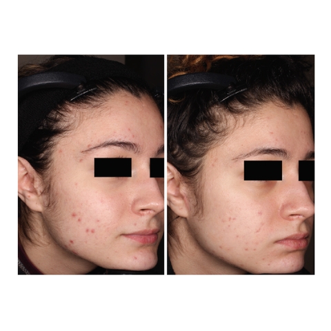 TAZAROTENE GEL 0.05% (TAZRET GEL): Gel Trị Mụn & Phục Hồi Sẹo Thâm - Tái Tạo Làn Da Sáng Khỏe