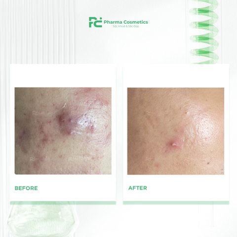 DECAAR ALGAE PEELING REGIMEN: Vi Tảo Sinh Trị Liệu Gen