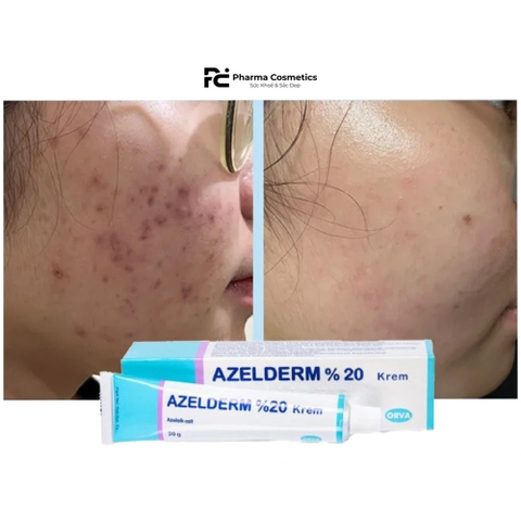 AZELDERM 20% KREM AZELAIC AICD 30g / KEM TRỊ MỤN, LÀM SÁNG VÀ ĐỀU MÀU DA
