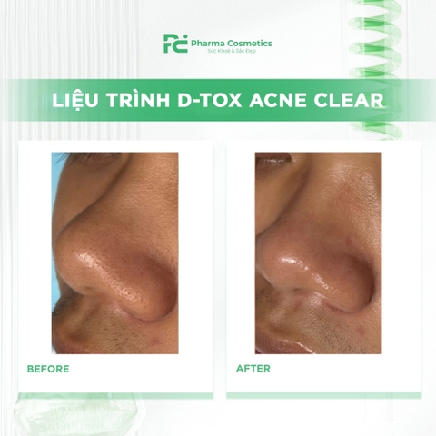 LIỆU TRÌNH D-TOX ACNE CLEAR Giải Pháp Trị Liệu Mụn Đa Tầng & Thanh Lọc Hệ Sinh Thái Da