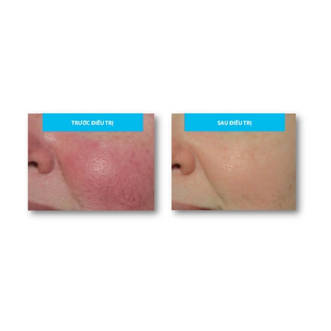 Md:cocktail Post-Treatment Skin Recovery – Serum Phục Hồi, Làm Dịu Da Tức Thì Sau Xâm Lấn