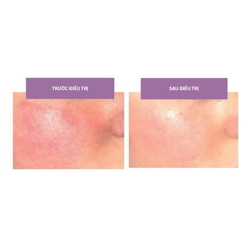 Md:cocktail RosalacSens Neutralizer – Giải Pháp Phục Hồi Da Nhạy Cảm & Giảm Đỏ Chuyên Sâu