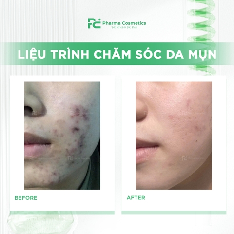 HISTOLAB LIỆU TRÌNH CHĂM SÓC DA MỤN CHUYÊN SÂU: Giải Pháp Thanh Lọc và Tái Tạo Làn Da Khỏe Mạnh