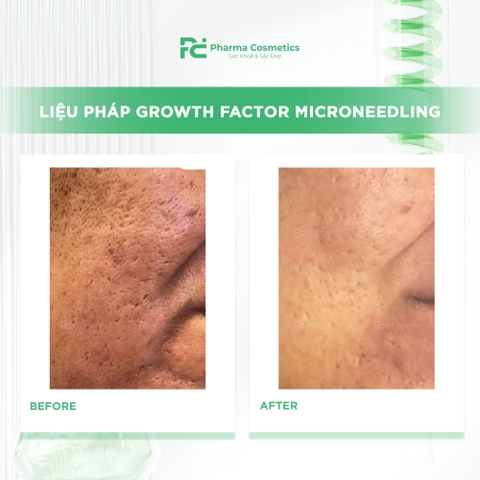 LIỆU PHÁP GROWTH FACTOR MICRONEEDLING: Giải Pháp Toàn Diện Cho Làn Da Sẹo Mụn, Lão Hóa, Thâm Nám