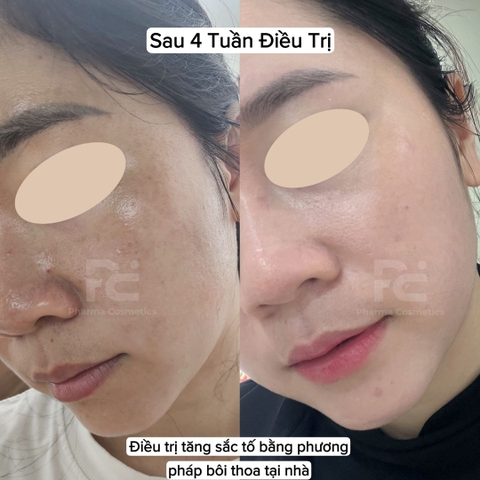 LACABINE 2% TRANEXAMIC ACID SERUM CREAM / KEM SERUM ĐẶC TRỊ NÁM SÁNG DA