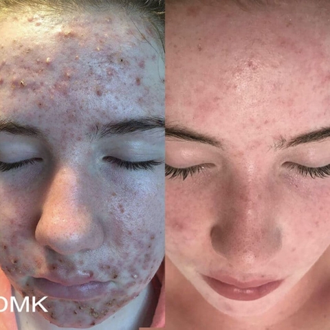 LIỆU PHÁP ENZYME THERAPY: Phục Hồi Làn Da 