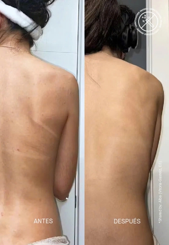 ACNEMY ZITBACK® BODY SPRAY FOR BLEMISH - PRONE SKIN / XỊT MỤN BODY 