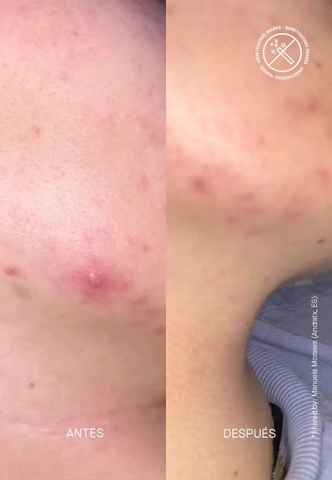 ACNEMY ZITCONTROL® BLEMISH CONTROL MOISTURIZER / KEM KIỂM SOÁT MỤN 