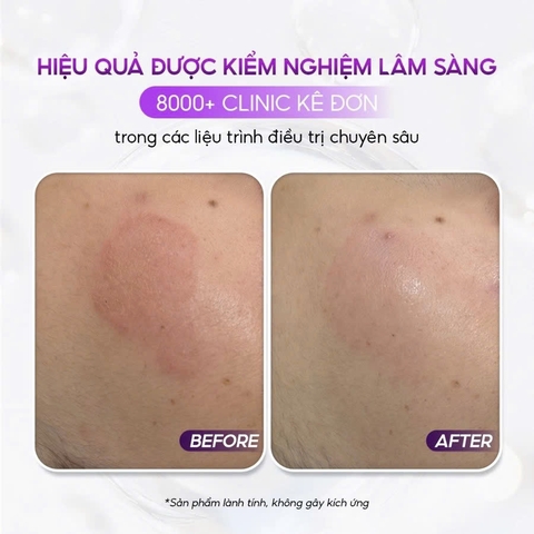 CONAPIDIL CEMENZAL LIGHT: Kem Dưỡng Tái Tạo Da, Hỗ Trợ Nâng Cơ & Cải Thiện Sẹo Rỗ