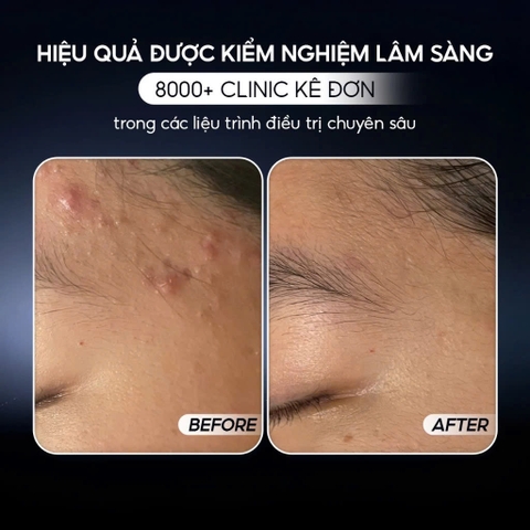 CONAPIDIL SUPERJECTION FIXCICA GEL: Gel Chuyên Biệt Giảm Mụn, Ngừa Thâm Sẹo & Phục Hồi Da Sau Trị Liệu