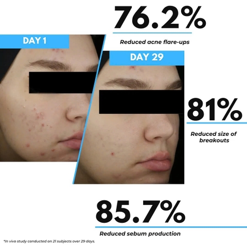 Synergy Therm Rosa Control Face Cream: Giải Pháp Toàn Diện Cho Da Nhạy Cảm Và Trứng Cá Đỏ