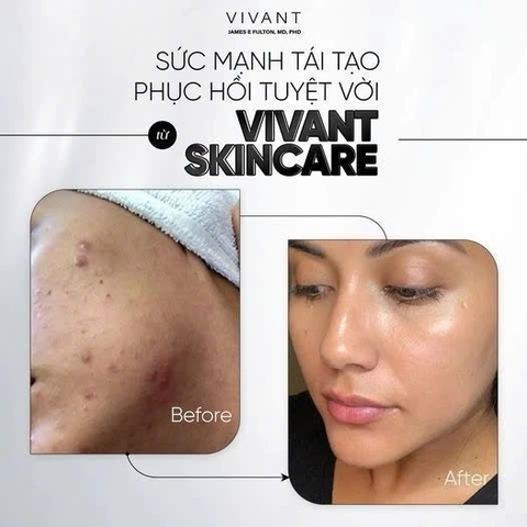 Vivant 8% Mandelic Acid Serum – Giải Pháp Tẩy Tế Bào Chết Dịu Nhẹ Cho Làn Da Sáng Mịn