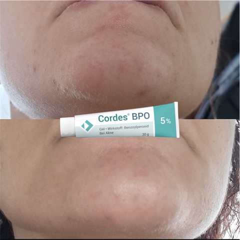 Cordes® BPO 5% Gel – Giải Pháp Đặc Trị Mụn Trứng Cá Cấp Độ Trung Bình