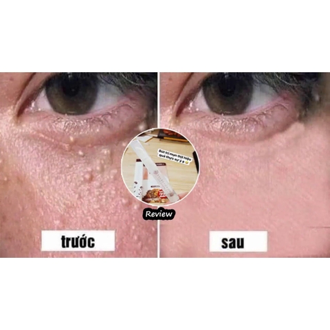 Kem Trị Mụn Thịt Mụn Gạo, Kem Xóa Nốt Ruồi Tsubuporon Nhật Bản 20g