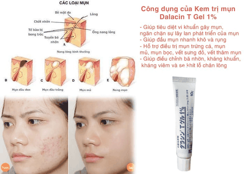 Kem trị mụn Dalacin T Gel 1% của Nhật Bản