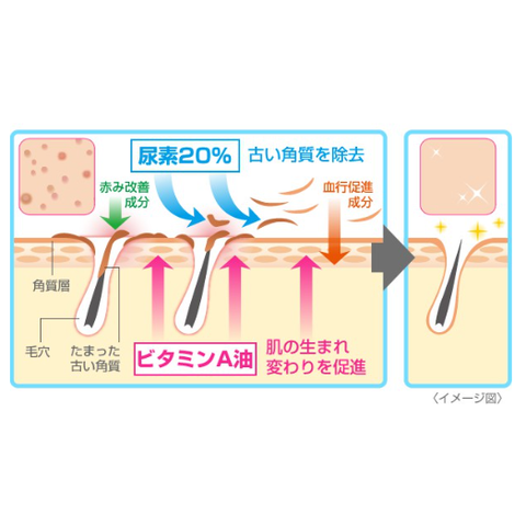 Kem Viêm Nang Lông Rohto Zaraporo 35g Nhật Bản