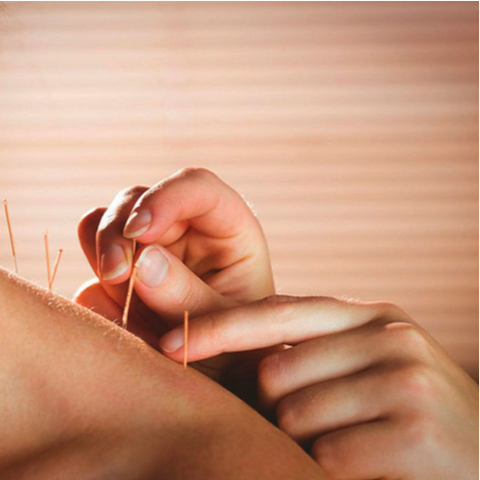 Cấy Chỉ Giảm Béo 5 - 8kg