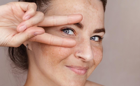 Đồi Mồi Tàn Nhang, Nám Da: Nguyên Nhân, Cách Phân Biệt Và Giải Pháp Cải Thiện Hiệu Quả