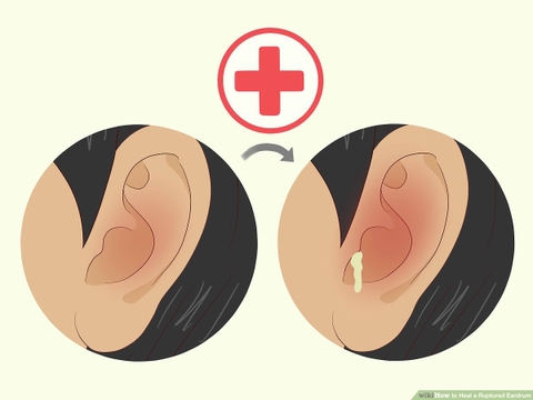 Thủng màng nhĩ – Nguy hiểm thầm lặng ảnh hưởng thính lực nếu chủ quan